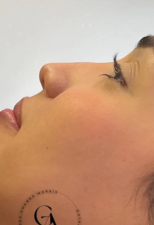 Perfil feminino: antes da harmonização orofacial, caso 3