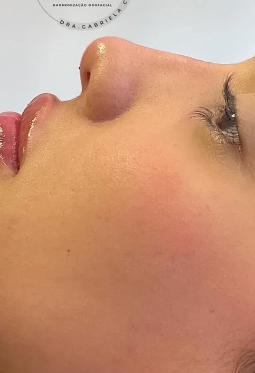 Perfil feminino: depois da harmonização orofacial, caso 3