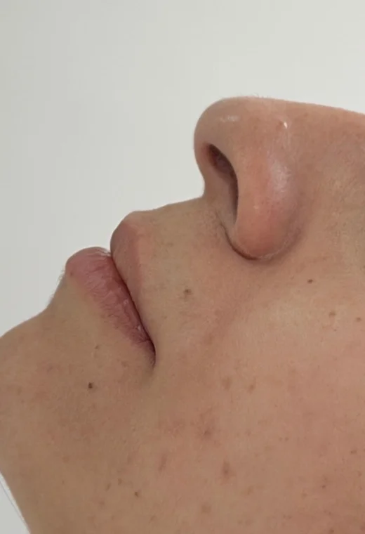 Perfil feminino: antes da harmonização orofacial, caso 2
