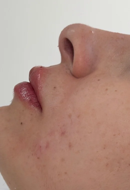 Perfil feminino: depois da harmonização orofacial, caso 2