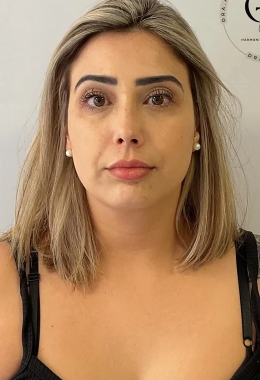 Visão frontal: antes da harmonização orofacial, caso 1