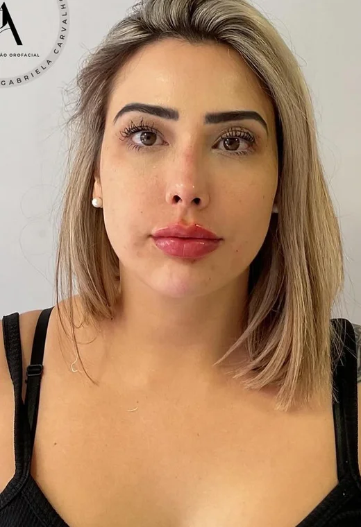 Visão frontal: depois da harmonização orofacial, caso 1