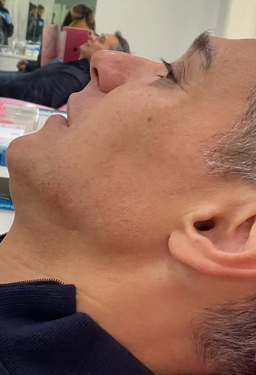 Perfil masculino: antes da harmonização orofacial, caso 4