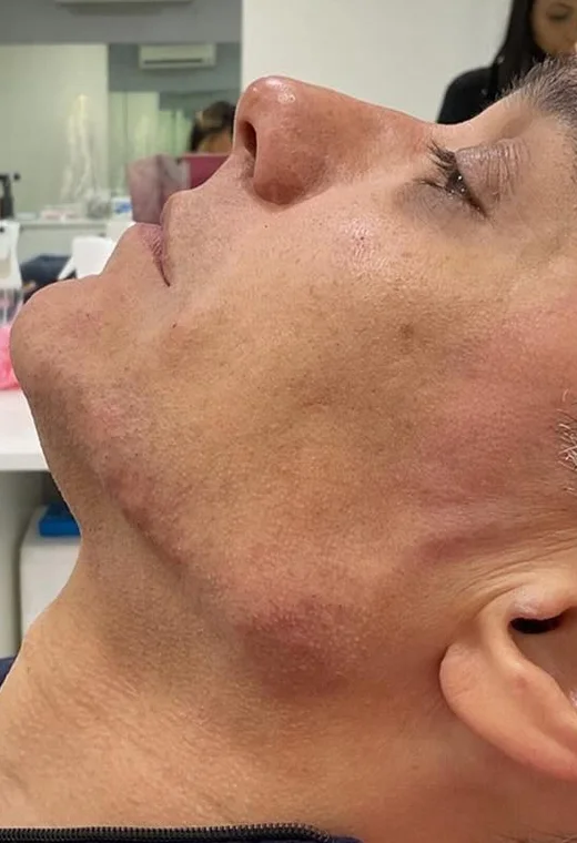 Perfil masculino: depois da harmonização orofacial, caso 4